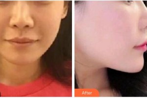 太原晉容整形美容門(mén)診部王雅爾整形價(jià)格表附埋線提升案例展示