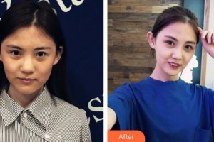 太原晉容整形美容門診部姜春生整形價格表附超聲提拉案例展示