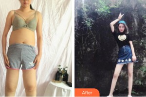 柳州仁美整形美容外科診所楊克整形價(jià)格表附大腿吸脂案例展示