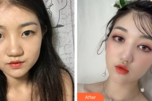 柳州美麗焦點醫(yī)療美容門診部唐超整形價格表附眼部手術案例展示