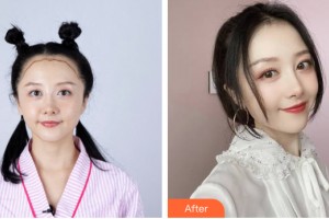 貴陽利美康醫(yī)院朱莉芳整形價(jià)格表附植發(fā)案例展示