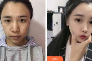 太原晉綺醫(yī)療美容診所顏崇文整形價(jià)格表附眼部綜合案例展示