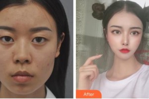 太原美媛薈整形美容醫(yī)院馮瑞錚整形價(jià)格表附眼部綜合案例展示