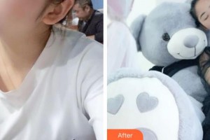 太原麗都整形美容醫(yī)院張德勇整形價(jià)格表附激光美膚激光案例展示