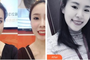 太原麗都整形美容醫(yī)院郭亞杰整形價(jià)格表附牙齒隱形矯正案例展示