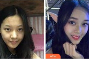 太原歐美蓮整形美容醫(yī)院康文娟整形價(jià)格表附膠原蛋白除皺案例展示