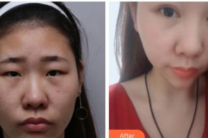 太原晉綺醫(yī)療美容診所簡(jiǎn)銘成整形價(jià)格表附眼部綜合案例展示