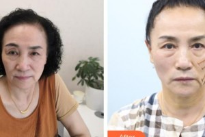 太原歐美蓮整形美容醫(yī)院李永生整形價(jià)格表附埋線提升案例展示