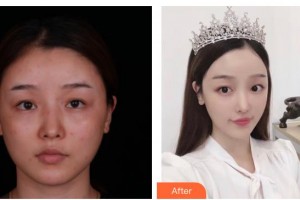 太原傾城醫(yī)療美容醫(yī)院張光文整形價(jià)格表附激光去眼袋案例展示