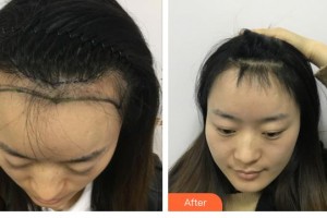 太原顯微手外科醫(yī)院毛發(fā)移植中心李愚炅整形價(jià)格表附種植發(fā)際線案例展示