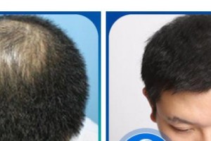 太原時(shí)光整形美容醫(yī)院邸紅亮整形價(jià)格表附頭頂加密種植案例展示