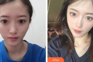 太原軍大醫(yī)療美容醫(yī)院王紅梅整形價(jià)格表附埋線提升案例展示