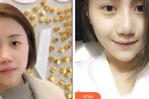 太原愛爾眼科醫(yī)院高海英整形價(jià)格表附切開雙眼皮案例展示