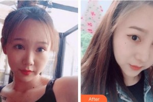 太原愛爾眼科醫(yī)院陳文娟整形價(jià)格表附鼻部綜合案例展示