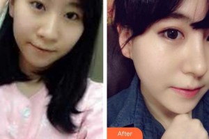 太原麗都整形美容醫(yī)院楊順新院長(zhǎng)整形價(jià)格表附鼻部綜合案例展示