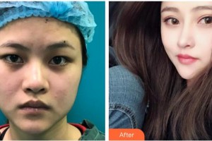 太原愛爾眼科醫(yī)院張嵐整形價(jià)格表附切開雙眼皮案例展示