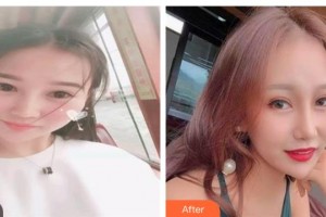 太原愛爾眼科醫(yī)院劉利整形價(jià)格表附眼部綜合案例展示