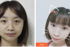 太原愛爾眼科醫(yī)院趙正梅整形價(jià)格表附眼部綜合案例展示