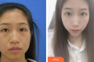 太原愛爾眼科醫(yī)院蘇艷麗整形價(jià)格表附激光去眼袋案例展示