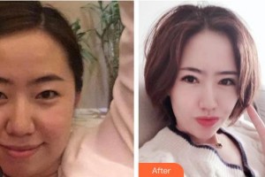 大同名仕醫(yī)療美容診所魯彥麟整形價(jià)格表附眼部綜合案例展示