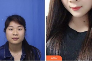 大同美神整形美容醫(yī)院賈文整形價(jià)格表附光子嫩膚案例展示