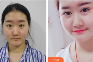 大同清木整形醫(yī)院陳秀琴整形價格表附熱瑪吉案例展示