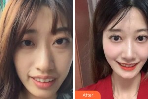 三亞口腔醫(yī)院符林整形價格表附牙齒矯正案例展示