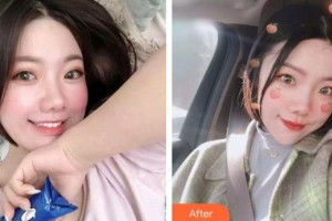 大同市第五人民醫(yī)院乳腺整形科雷建如整形價格表附埋線提升案例展示