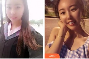 大同清木整形醫(yī)院趙榮整形價(jià)格表附埋線提升案例展示