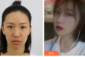 大同清木整形醫(yī)院楊崇志整形價(jià)格表附眼部綜合案例展示