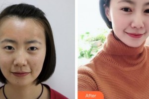 大同清木整形醫(yī)院李楠整形價(jià)格表附切開雙眼皮案例展示