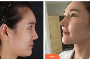 陽泉煤業(yè)集團總醫(yī)院整形美容科郭志權整形價格表附肋軟骨隆鼻案例展示