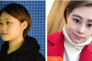 陽泉美亞醫(yī)療美容診所李茹英整形價格表附鼻部綜合案例展示