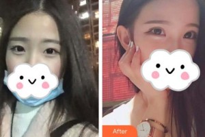 長治亮麗保健醫(yī)學美容診所王佳琦整形價格表附眼部綜合案例展示