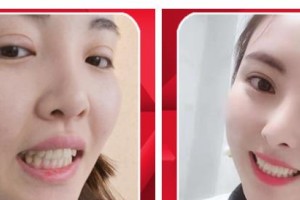 長治同康眼科醫(yī)院鄭東萍整形價格表附貴金屬烤瓷牙案例展示