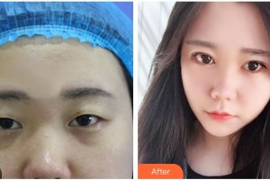 長治天成醫(yī)療美容診所郭妍整形價格表附定點雙眼皮案例展示