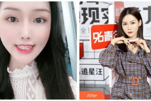 長治億大口腔醫(yī)院李維文整形價格表附金屬托槽矯正案例展示