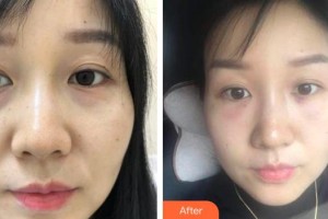 晉城市眼科醫(yī)院尚利霞整形價格表附激光去眼袋案例展示