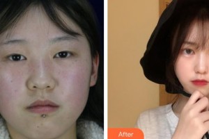 晉城鳳凰整形美容醫(yī)院尹琥珠整形價格表附開內眼角案例展示