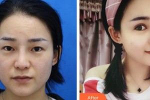 晉城鳳凰整形美容醫(yī)院李永立整形價格表附眼部綜合案例展示