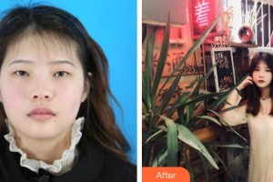 晉城市眼科醫(yī)院韋云艷整形價格表附眼部綜合案例展示