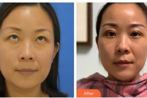 晉城俏麗醫(yī)療美容門診部趙利慶整形價格表附切開雙眼皮案例展示