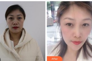 晉城俏麗醫(yī)療美容門診部杜銀燕整形價格表附眼部綜合案例展示