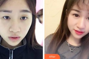 晉中鷹華眼科醫(yī)院郭新整形價(jià)格表附切開雙眼皮案例展示