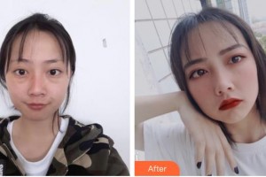 晉中鷹華眼科醫(yī)院石一寧整形價(jià)格表附激光去眼袋案例展示