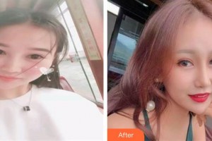 晉中鷹華眼科醫(yī)院王艷華整形價(jià)格表附眼部綜合案例展示