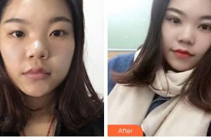 晉中鷹華眼科醫(yī)院史彩霞整形價(jià)格表附切開雙眼皮案例展示