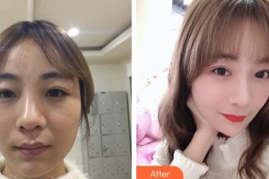 晉中鷹華眼科醫(yī)院張東昌整形價(jià)格表附眼部綜合案例展示