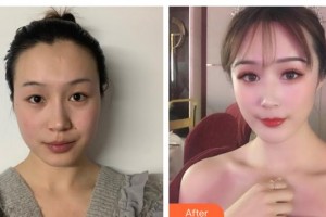 運(yùn)城市第一醫(yī)院燒傷整形美容科郭靜整形價(jià)格表附自體脂肪全臉填充案例展示