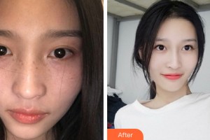 三亞三仁醫(yī)療美容醫(yī)院宋瑋瑋整形價格表附皮膚美容案例展示